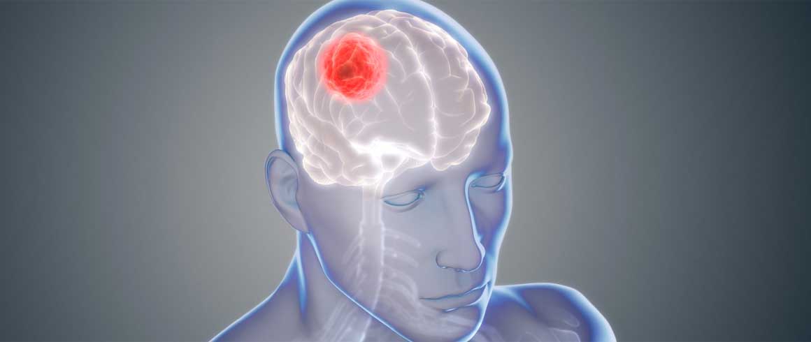 Un anticorpo contro il glioblastoma