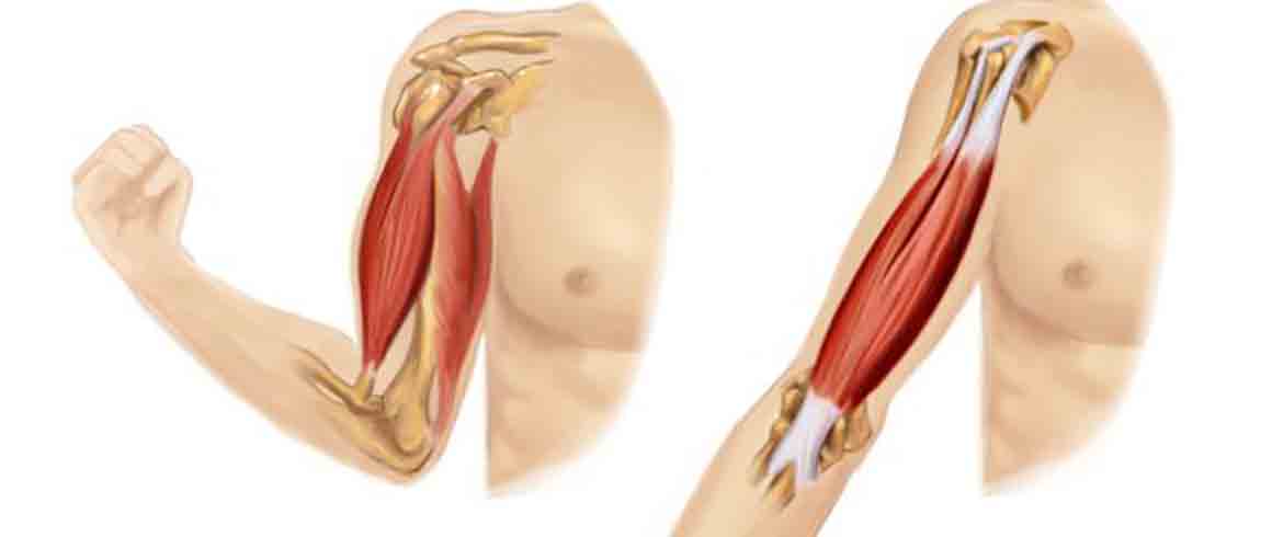 La sindrome di Down accelera l'invecchiamento muscolare