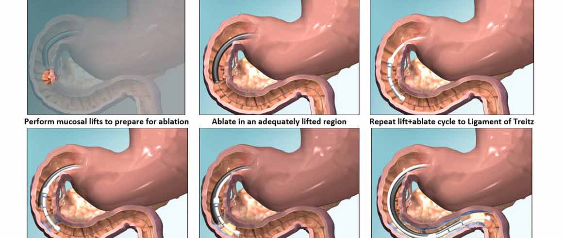 Il calore per trattare il diabete