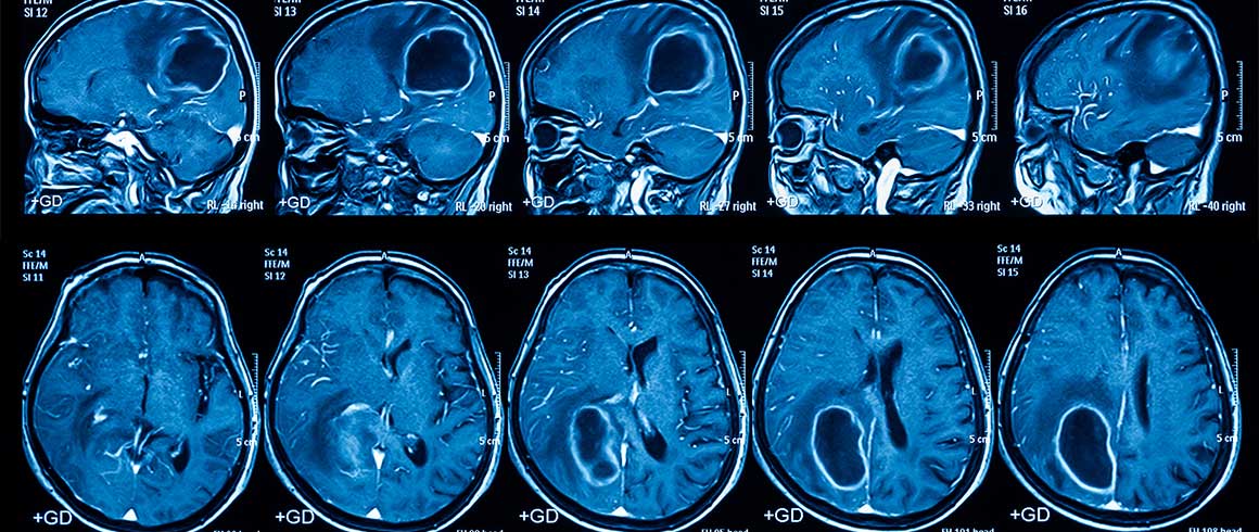 Riprodotto in provetta il glioblastoma